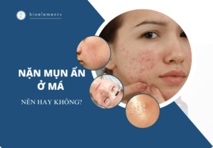 Cách nặn mụn ẩn ở má