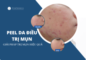 Peel da điều trị mụn